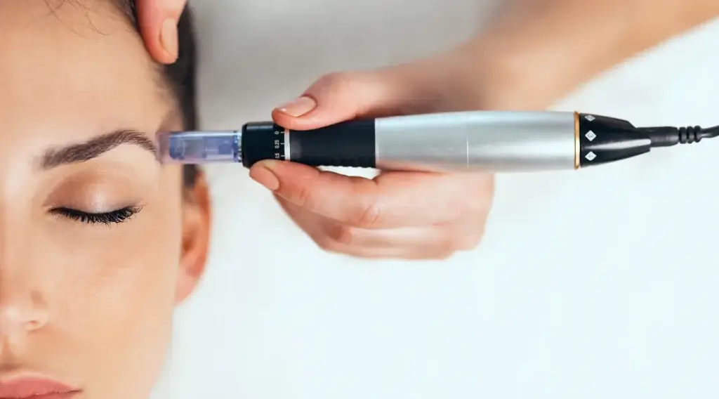 microneedling-rodgau