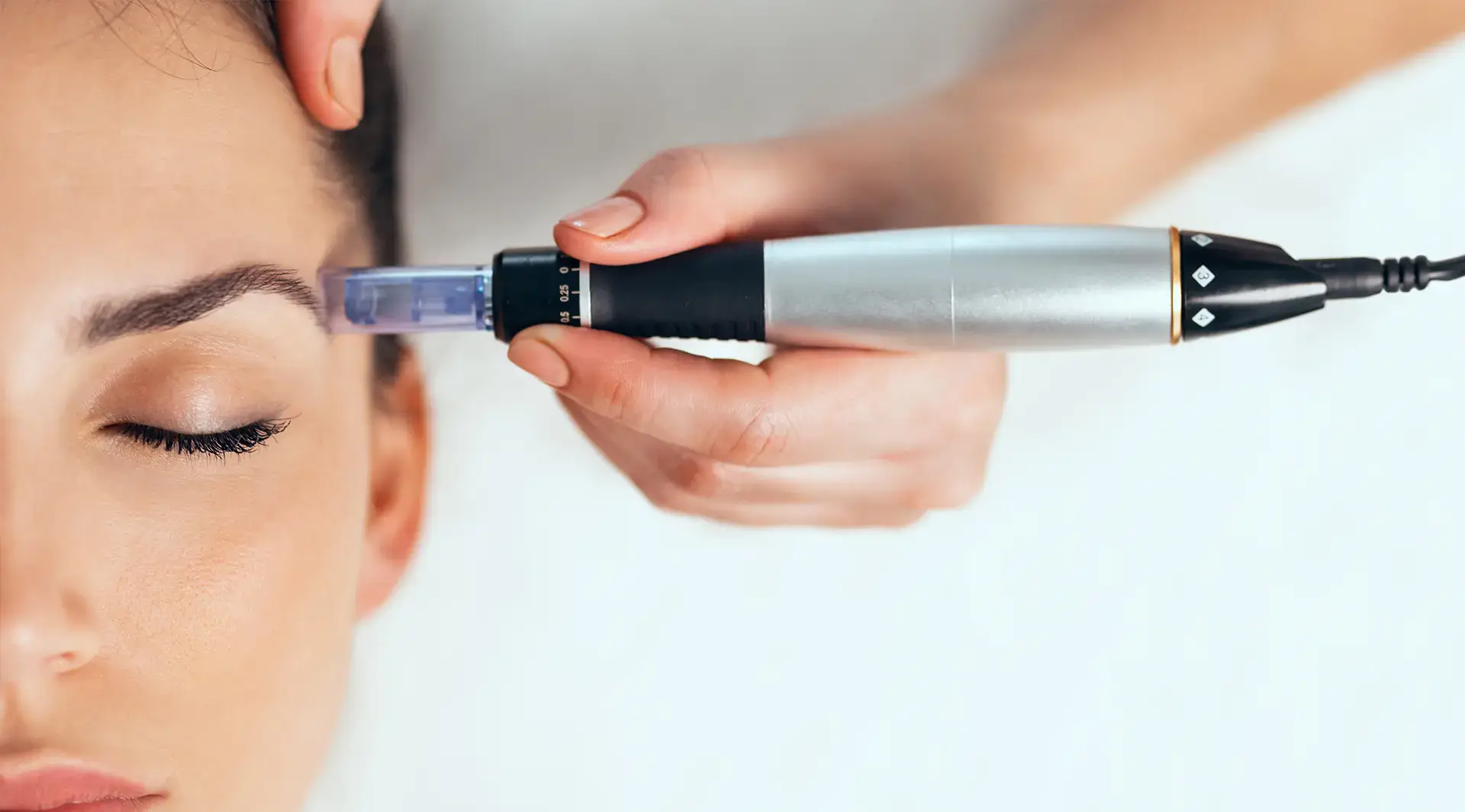 microneedling-rodgau